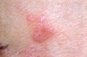 Can I Remove Lichen Planus Marks With Herbal Product?