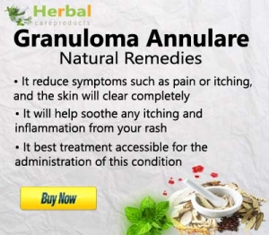 Interstitial Granuloma Annulare Treatment Reviews 2023 